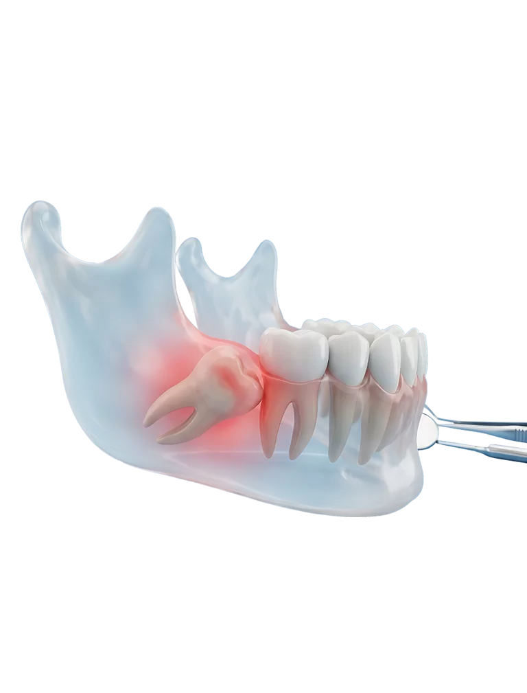 Gömülü Diş Cerrahileri